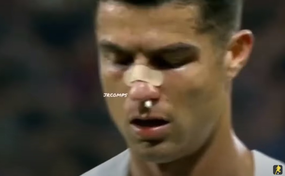 Ronaldo bê bết máu vì bị thủ môn đối phương đấm gãy mũi